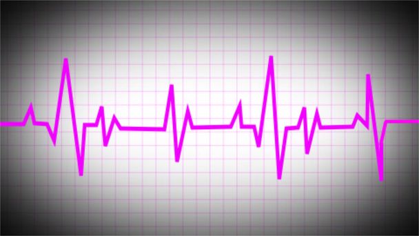 Een elektrocardiogram onthult patroon van sinus tachycardie. Fibrilleren van het hart. De hartslag. Reanimatie. ECG. ECG. een indicatie van leven. steun voor het leven. Ontmantelen. Noodgeval. gezondheidssymbool in de geneeskunde. - Foto, afbeelding