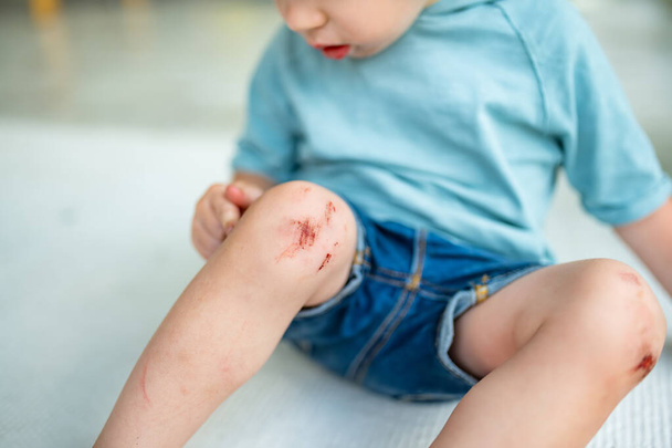 Toddler boy with sore scraped knees. Parent helping her child perform first aid knee injury after he has been an accident. - Foto, immagini