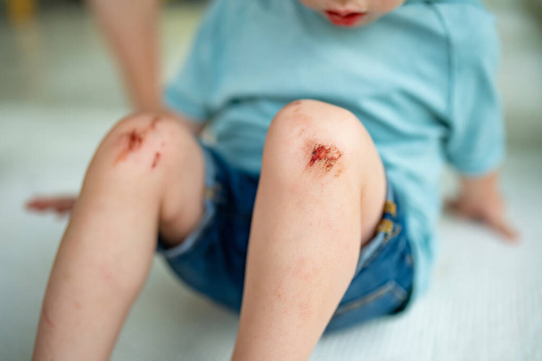 Toddler boy with sore scraped knees. Parent helping her child perform first aid knee injury after he has been an accident. - Foto, Imagem