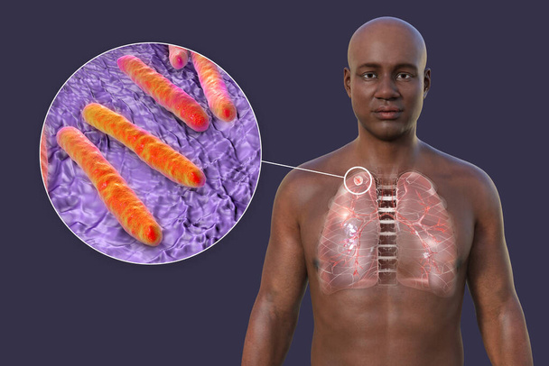 Een 3D-illustratie van het bovenste deel van een Afrikaanse man met een transparante huid, die de longen blootlegt die door secundaire tuberculose zijn aangetast en een close-upbeeld geeft van Mycobacterium tuberculosis bacteriën - Foto, afbeelding