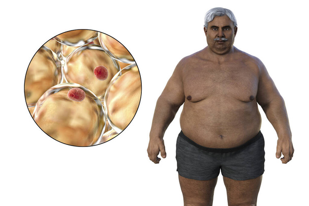 Un'illustrazione medica 3D raffigurante un uomo anziano in sovrappeso con una visione ravvicinata degli adipociti, evidenziando il ruolo di queste cellule di grasso nell'obesità. - Foto, immagini