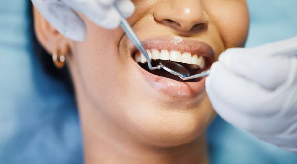 Dentist, mirror and hands, patient mouth and medical tools, surgery and dental health. Tooth decay, healthcare and people at orthodontics clinic for oral care, metal instrument and gingivitis. - 写真・画像