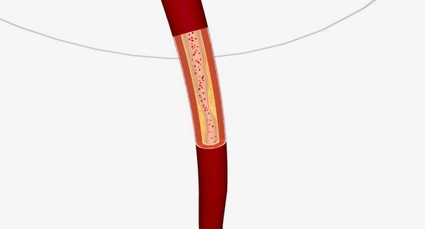Kapea verisuonten alaraajojen Alaraajojen valtimon interventio voi sisältyä pallolaajennus, stentit, tai aterektomia. 3D-renderointi - Valokuva, kuva