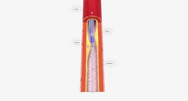 L'angioplastie est une procédure mini-invasive qui utilise un cathéter avec une pointe de ballon pour élargir votre artère bloquée. rendu 3D - Photo, image