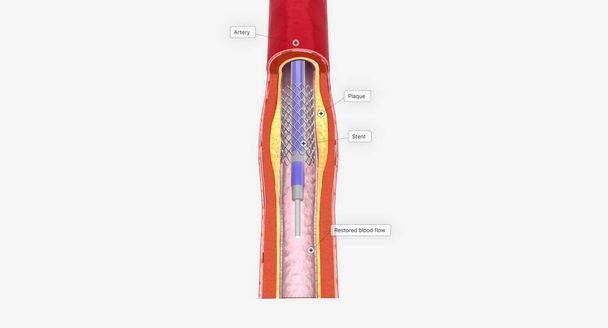 Une endoprothèse peut être mise en place pour prévenir le blocage à l'avenir. rendu 3D - Photo, image