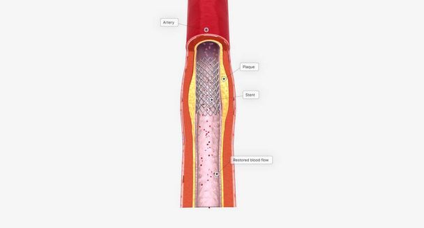 Une endoprothèse peut être mise en place pour prévenir le blocage à l'avenir. rendu 3D - Photo, image