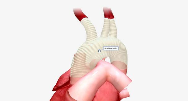 Une greffe synthétique est un tube artificiel qui permet au sang oxygéné de circuler du cœur vers le reste du corps. rendu 3D - Photo, image