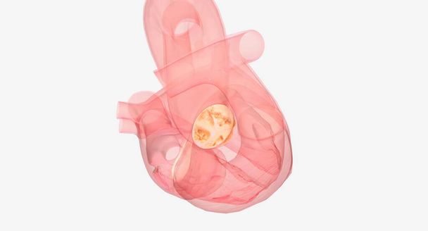 El reemplazo y reparación de la válvula aórtica son procedimientos quirúrgicos a corazón abierto para tratar la estenosis aórtica, que es una válvula cardíaca estrecha que no puede abrirse y cerrarse adecuadamente. Renderizado 3D - Foto, imagen