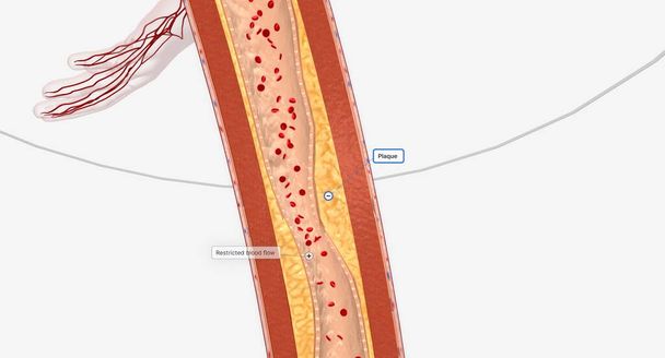 Vaisseau sanguin rétréci dans les membres inférieurs L'intervention artérielle dans les membres inférieurs peut inclure une angioplastie, des endoprothèses ou une athérectomie. rendu 3D - Photo, image