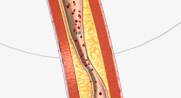 Atherosclerosis is the plaque buildup in the walls of the arteries. 3D rendering - Zdjęcie, obraz