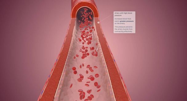 Nadciśnienie powoduje wysokie ciśnienie krwi, gdy siła wywierana przez krew na ścianach tętnicy jest zbyt duża. Renderowanie 3D - Zdjęcie, obraz