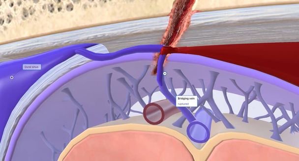Krev, která se shromažďuje mezi dura mater a arachnoid mater se nazývá subdurální hematom. 3D vykreslování - Fotografie, Obrázek