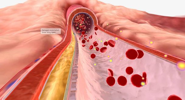 Hiperlipidemia występuje, gdy stężenia lipidów w krwiobiegu są wyższe niż normalnie. Renderowanie 3D - Zdjęcie, obraz