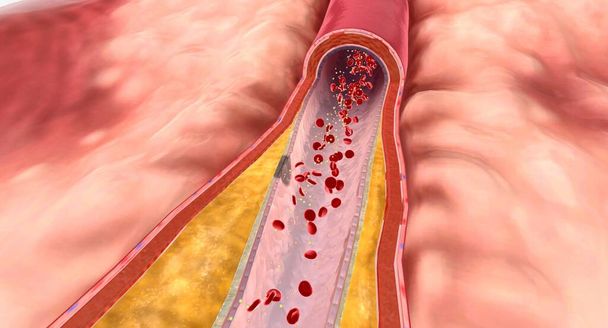 W hiperlipidemii, nadmiar lipidów może budować się na ścianach tętnicy i tworzą substancję tłuszczową o nazwie płytka. Renderowanie 3D - Zdjęcie, obraz