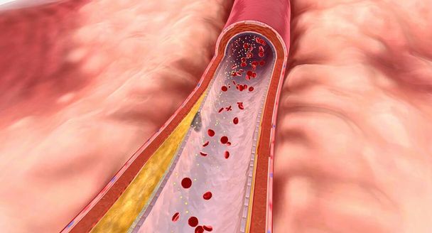 In hyperlipidemie, overtollige lipiden kunnen opbouwen op de slagaderwanden en vormen een vettige stof genaamd plaque. 3D Render - Foto, afbeelding