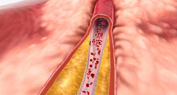 Comme l'hyperlipidémie se poursuit au fil du temps, la plaque peut croître et limiter le flux sanguin à travers une artère. Expéditeur 3D - Photo, image