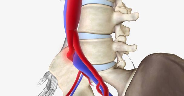 Le syndrome de May Thurner est une compression de la veine iliaque commune gauche entre l'artère iliaque commune droite et la 5e vertèbre lombaire de la colonne vertébrale. rendu 3D - Photo, image
