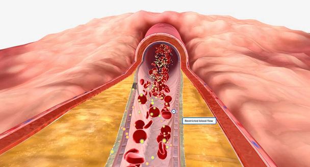 Naarmate hyperlipidemie blijft na verloop van tijd, plaque kan groeien en beperken bloedstroom door een slagader. 3D Render - Foto, afbeelding