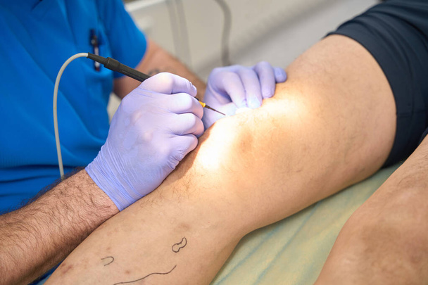 Vágott fénykép sebészeti beavatkozás során, elektrokoagulátorral a beteg lábán - Fotó, kép