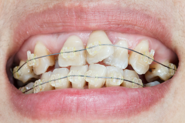 Close-up στόμα του στραβά δόντια με σιδεράκια. - Φωτογραφία, εικόνα