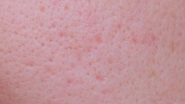 Close-up of skin with large pores and blemishes. Girl with problem skin. Extreme closeup of texture of problem human skin with large open pores, acne scars. - Footage, Video