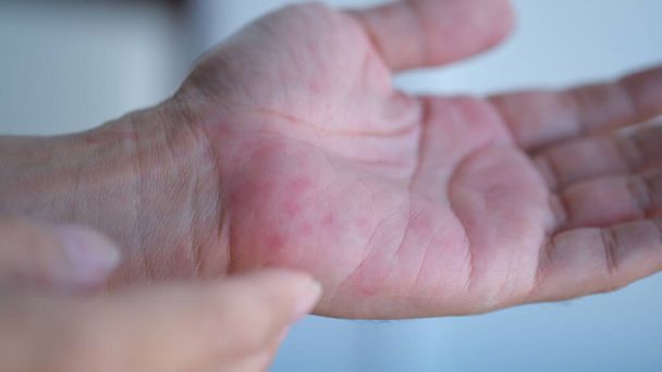 Skin hives allergies on the palms or urticaria or biduran. - Photo, Image