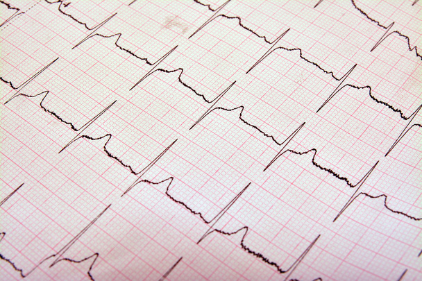 EKG grafikon - Fotó, kép