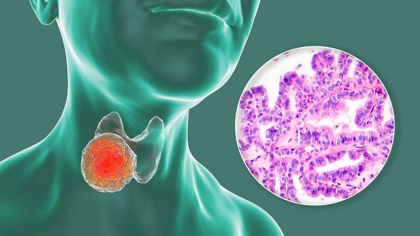 Μια τρισδιάστατη επιστημονική απεικόνιση που δείχνει ένα ανθρώπινο σώμα με διαφανές δέρμα, αποκαλύπτοντας έναν όγκο στον θυρεοειδή αδένα του, μαζί με μια μικρογραφική εικόνα του καρκίνου του θυρεοειδούς των θηλαστικών. - Φωτογραφία, εικόνα