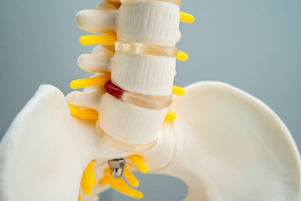 腰椎は関節のディスクの断片、脊髄神経、骨を脱臼させた。整形外科における治療医療モデル. - 写真・画像