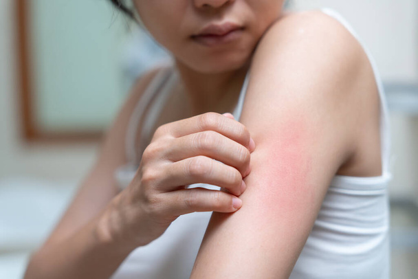 skin problem and beauty. Young woman scratch body has itchy skin from skin allergic, steroid allergy, sensitive skin, red from sunburn, chemical allergy, rash, insect bites, Seborrheic Dermatitis. - Foto, Bild