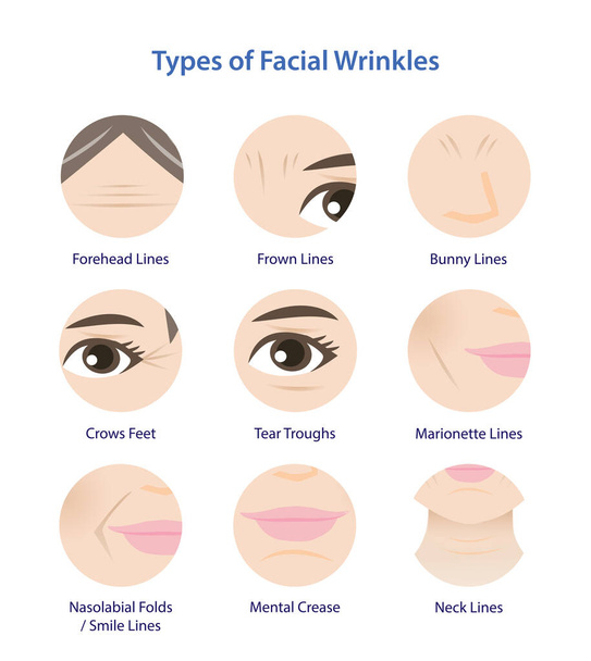 Types of facial wrinkles vector icon set illustration isolated on white background. Icon set of Forehead, Bunny, Marionette, Frown lines, Mental crease, Crows feet, Tear troughs, Nasolabial folds, Smile and Neck lines. - Vector, Image