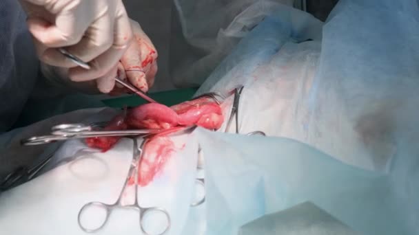 Ręce chirurga wykonują skomplikowaną operację chirurgiczną na sali operacyjnej. Zbliżenie. - Materiał filmowy, wideo
