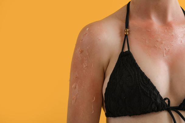 Alergická mladá žena s opálenou pletí na žlutém pozadí - Fotografie, Obrázek