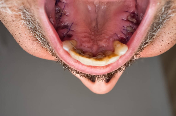 Detalhe do palato macho superior com a gengiva costurada após a extração dos molares, com splinting nos dentes incisivos. - Foto, Imagem