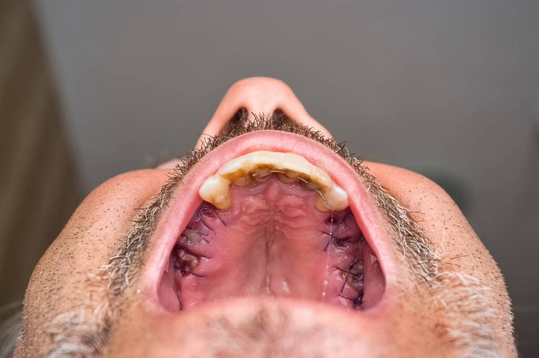 Detalle del paladar superior masculino con la encía cosida después de la extracción de los molares, con entablillado en los dientes incisivos. - Foto, Imagen