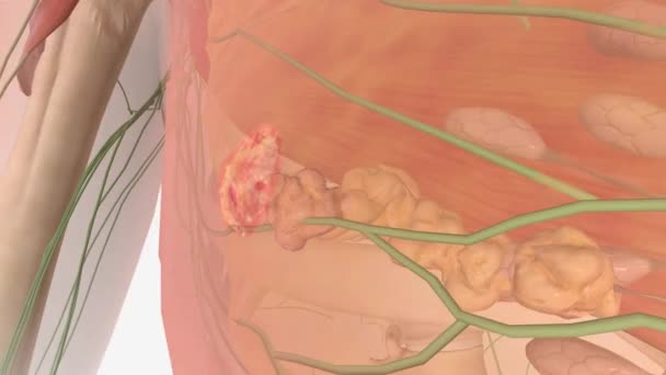 Stage III tumor spread deep inside the breast - Footage, Video