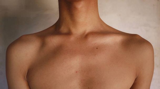 Zdjęcie ramienia i klatki piersiowej cienkiego człowieka, można zobaczyć asymetryczny kształt ciała, widoczne kości ciała - Zdjęcie, obraz