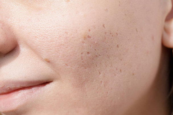 Young woman suffering from problem skin and acne closeup. Icepick scars acne on cheek  - Foto, Imagen