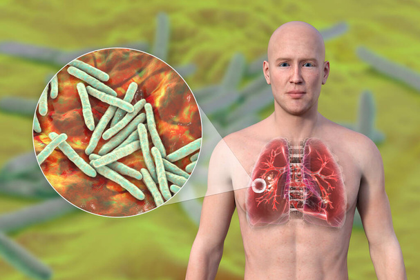 Een 3D fotorealistische illustratie van de bovenste helft van een man met een transparante huid, die de longen vertoont die aangetast zijn door holle tuberculose, en een close-up van Mycobacterium tuberculosis bacteriën. - Foto, afbeelding