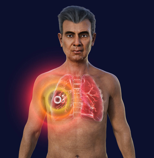 Illustrazione fotorealistica 3D della metà superiore di un uomo con pelle trasparente, che mostra i polmoni affetti da tubercolosi cavernosa. - Foto, immagini