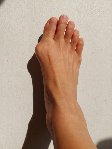 A woman right foot with hallux valgus, Foot Bunions, Bony Bump. - Foto, immagini