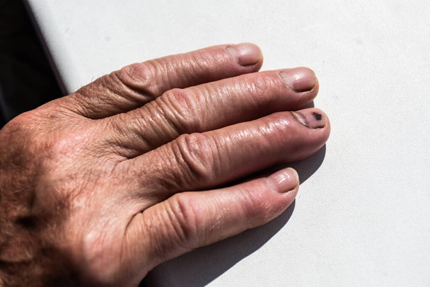 A man's hand with a broken finger, without bandages. - Photo, Image