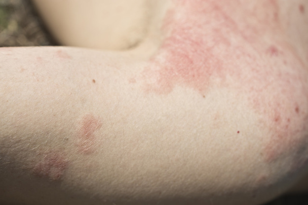 skin dermatitis - Photo, Image
