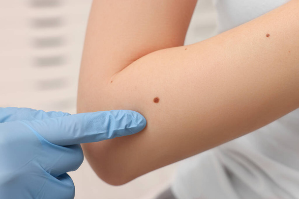 Dermatologist in rubber glove examining patient's birthmark on blurred background, closeup - Φωτογραφία, εικόνα