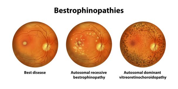 Bestrofinopatías, trastornos hereditarios de la retina causados por mutaciones en el gen BEST1, ilustración. Mejor enfermedad, bestrofinopatía autosómica recesiva, vitreorretinocoroidopatía autosómica dominante - Foto, imagen