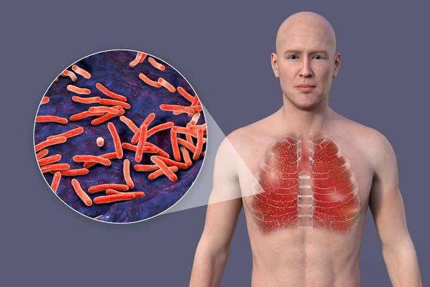 Uma ilustração 3D mostrando a metade superior de um homem com pele transparente, revelando os pulmões afetados pela tuberculose miliar e visão de perto das bactérias Mycobacterium tuberculosis. - Foto, Imagem