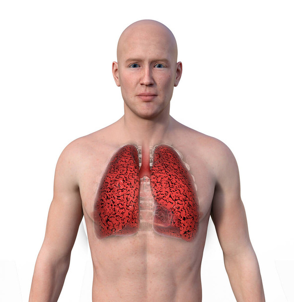 3D фотореалистичная иллюстрация верхней половины человека с прозрачной кожей, раскрывающая состояние легких курильщика. - Фото, изображение