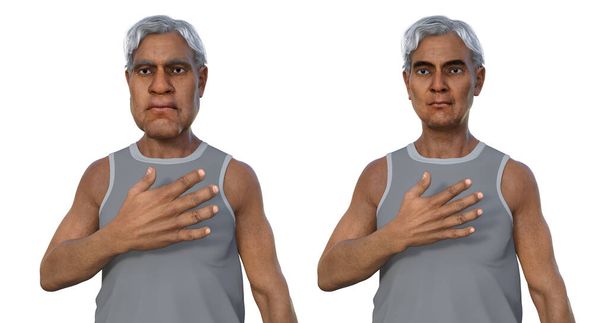 Ακρομεγαλία σε έναν άνθρωπο, και τον ίδιο υγιή άνθρωπο. 3D απεικόνιση που δείχνει αύξηση του μεγέθους των χεριών και του προσώπου λόγω υπερπαραγωγής σωματοτροπίνης που προκαλείται από όγκο της υπόφυσης. - Φωτογραφία, εικόνα