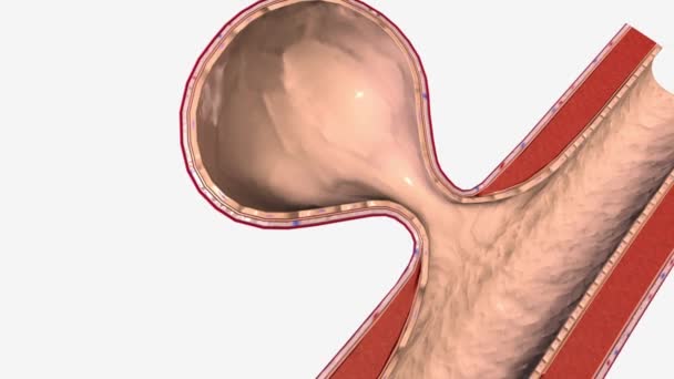 Bobule (saccular) výdutě jsou nejčastějším typem intrakraniální aneurysma - Záběry, video