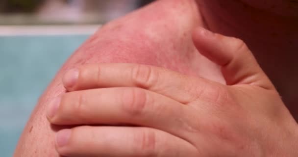 Muž škrábání zarudlé kožní vyrážku s rukou detailní 4k filmu. Koncept alergie na slunce - Záběry, video